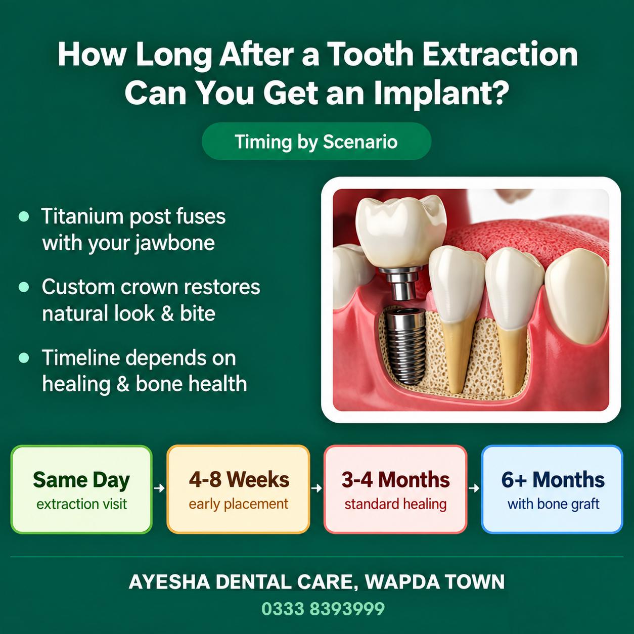 Dental implant placement timeline after tooth extraction, from same-day treatment to six or more months with a bone graft